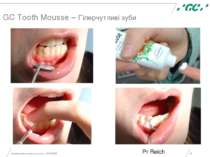 Минимальное вмешательство, 15/05/2006 * GC Tooth Mousse – Гіперчутливі зуби P...