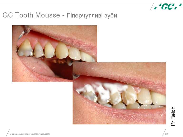 Минимальное вмешательство, 15/05/2006 * GC Tooth Mousse - Гіперчутливі зуби P...