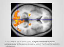 Отримане за домомогою ядерного магнітного резонансу зображення змін у мозку л...