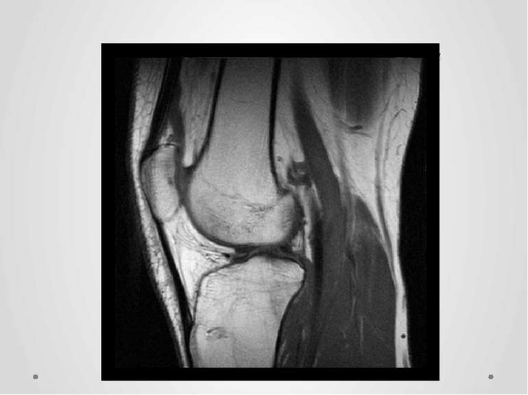 Магнітно – резонансне зображення коліна