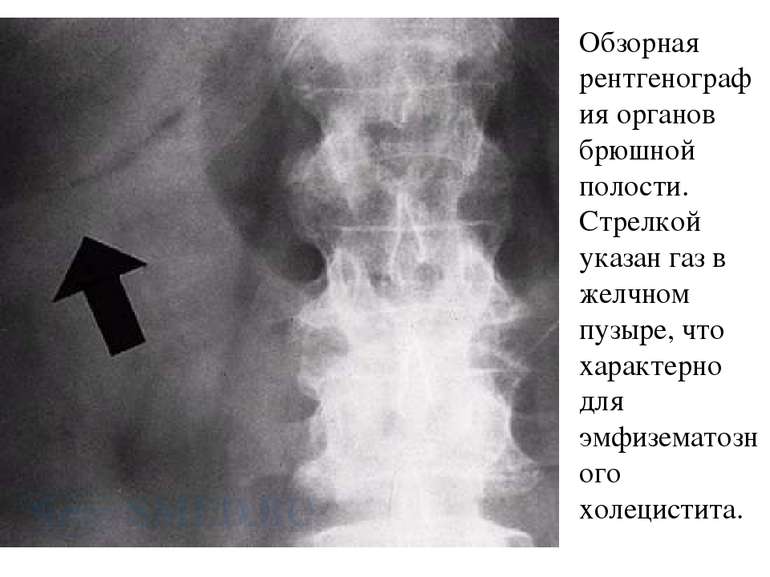 Обзорная рентгенография органов брюшной полости. Стрелкой указан газ в желчно...