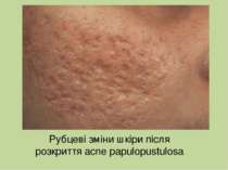 Рубцеві зміни шкіри після розкриття acne papulopustulosa