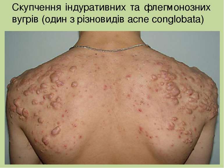 Скупчення індуративних та флегмонозних вугрів (один з різновидів acne conglob...