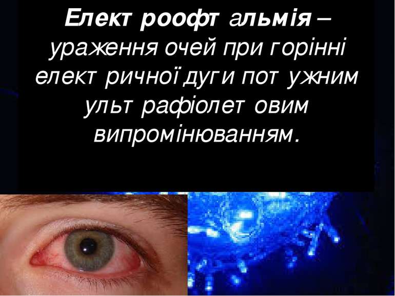 Електроофтальмія – ураження очей при горінні електричної дуги потужним ультра...