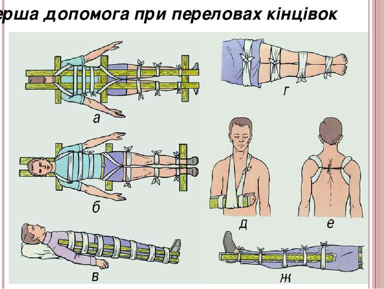 Перша допомога при переловах кінцівок