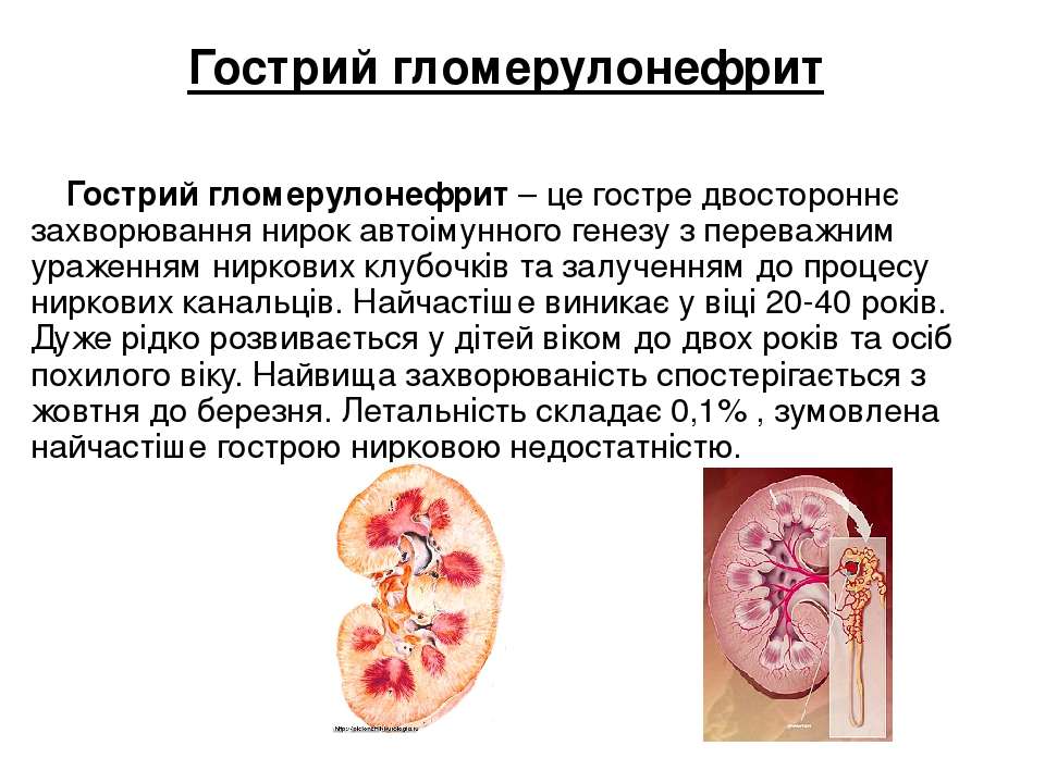 Острый гломерулонефрит картинки