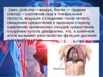  (греч. pnéuma —воздух, thorax — грудная клетка) – скопление газа в плевральн...