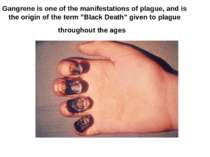 Gangrene is one of the manifestations of plague, and is the origin of the ter...