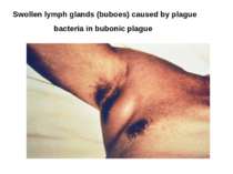 Swollen lymph glands (buboes) caused by plague bacteria in bubonic plague