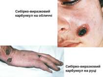 Сибірко-виразковий карбункул на обличчі Сибірко-виразковий карбункул на руці