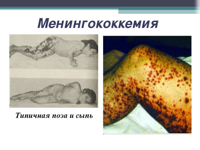 Менингококкемия Типичная поза и сыпь