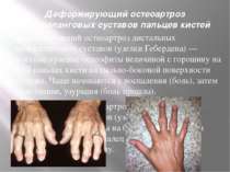 Деформирующий остеоартроз межфаланговых суставов пальцев кистей Деформирующий...