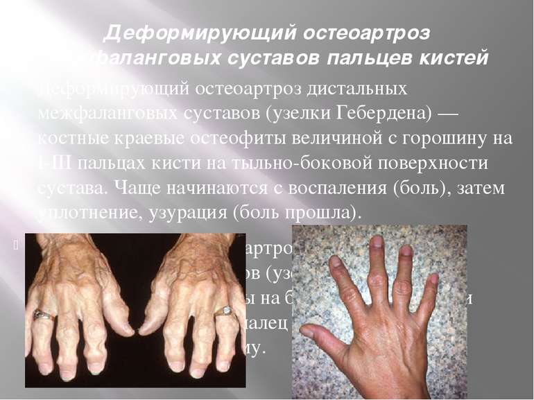 Деформирующий остеоартроз межфаланговых суставов пальцев кистей Деформирующий...