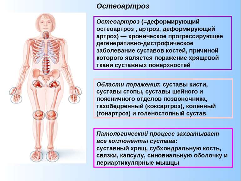 Остеоартроз (=деформирующий остеоартроз , артроз, деформирующий артроз) — хро...