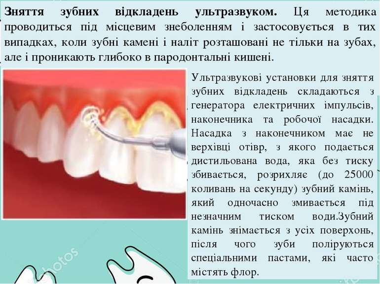 Зняття зубних відкладень ультразвуком. Ця методика проводиться під місцевим з...