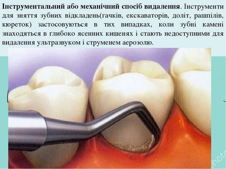 Інструментальний або механічний спосіб видалення. Інструменти для зняття зубн...