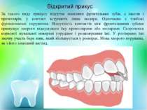 Відкритий прикус За такого виду прикусу відсутнє змикання фронтальних зубів, ...