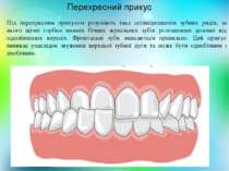 Перехресний прикус Під перехресним прикусом розуміють таке співвідношення зуб...