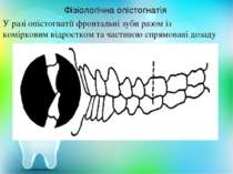 У разі опістогнатії фронтальні зуби разом із комірковим відростком та частино...