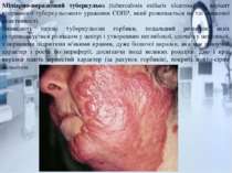 Міліарно-виразковий туберкульоз (tuberculosis miliaris ulcerosa) — варіант вт...