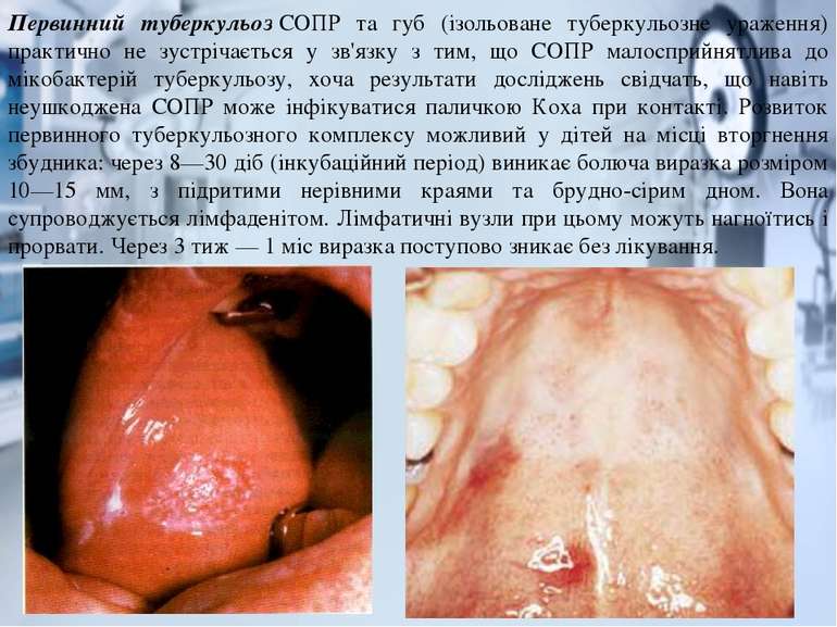 Первинний туберкульоз СОПР та губ (ізольоване туберкульозне ураження) практич...