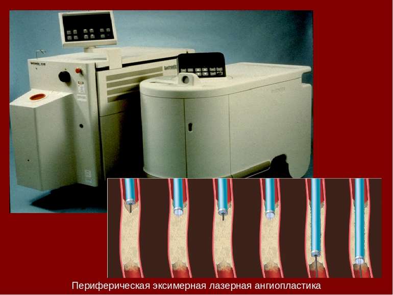 Периферическая эксимерная лазерная ангиопластика