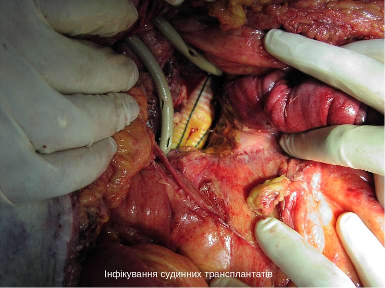 Інфікування судинних трансплантатів