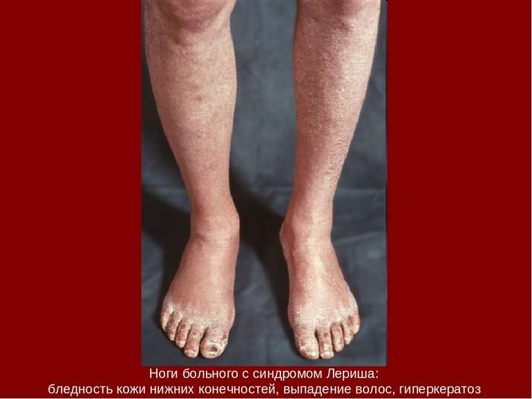 Ноги больного с синдромом Лериша: бледность кожи нижних конечностей, выпадени...