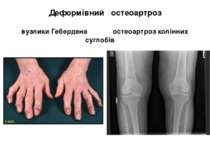 Деформівний остеоартроз вузлики Гебердена остеоартроз колінних суглобів