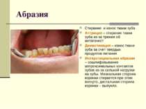 Абразия Стирание и износ ткани зуба Аттриция – стирание ткани зуба из-за трен...