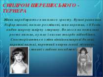 СИНДРОМ ШЕРЕШЕСЬКОГО - ТЕРНЕРА   Жінки народжуються низького зросту. Вушні ра...