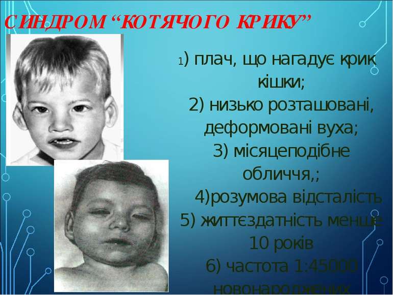 СИНДРОМ “КОТЯЧОГО КРИКУ” 1) плач, що нагадує крик кішки; 2) низько розташован...