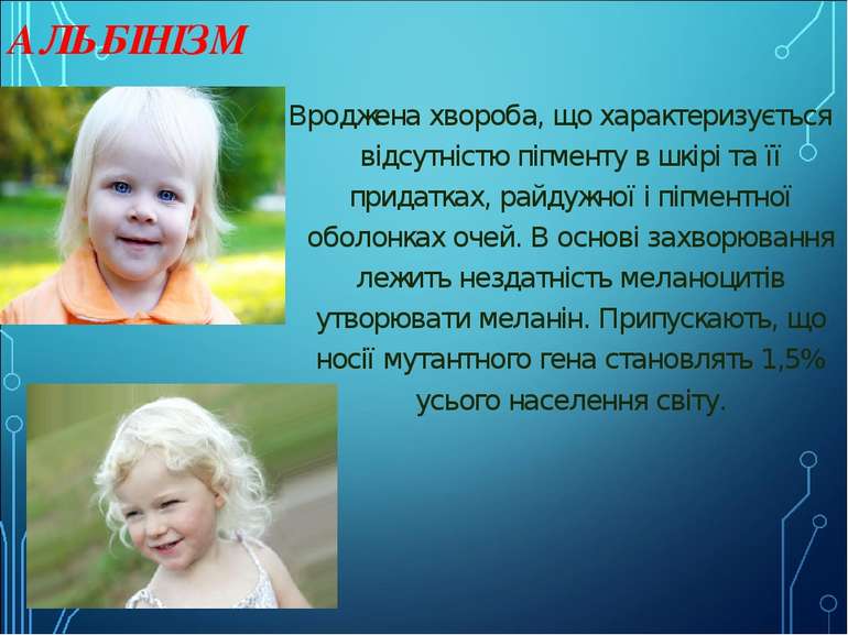 АЛЬБІНІЗМ Вроджена хвороба, що характеризується відсутністю пігменту в шкірі ...