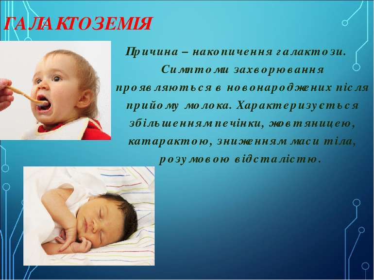 ГАЛАКТОЗЕМІЯ Причина – накопичення галактози.  Симптоми захворювання проявляю...