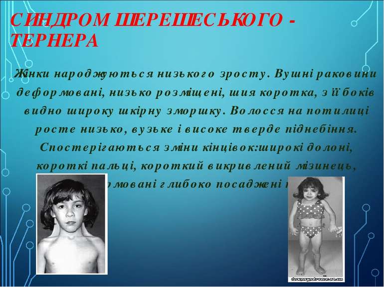 СИНДРОМ ШЕРЕШЕСЬКОГО - ТЕРНЕРА   Жінки народжуються низького зросту. Вушні ра...