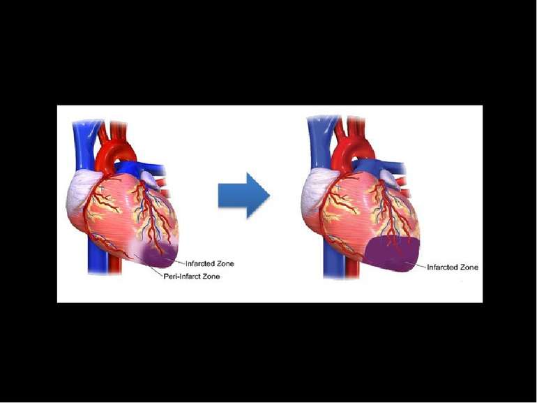 У пері-інфарктній ділянці на ранньому етапі інфаркту знаходяться клітини, в п...