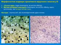 Морфологічні маркери хронічного вірусного гепатиту В: «Пісочні ядра» (ядра ге...