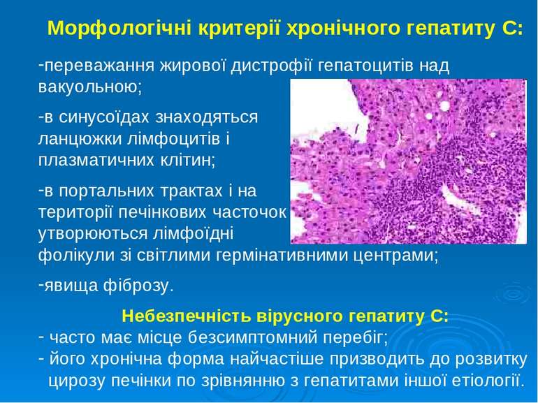 Морфологічні критерії хронічного гепатиту С: переважання жирової дистрофії ге...