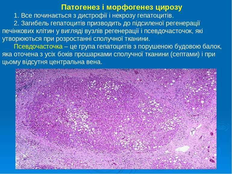 Патогенез і морфогенез цирозу 1. Все починається з дистрофії і некрозу гепато...