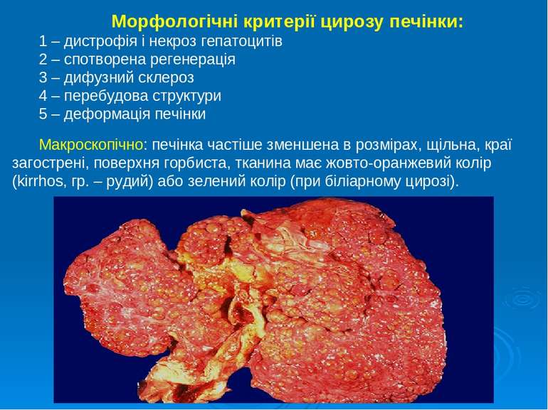 Морфологічні критерії цирозу печінки: 1 – дистрофія і некроз гепатоцитів 2 – ...
