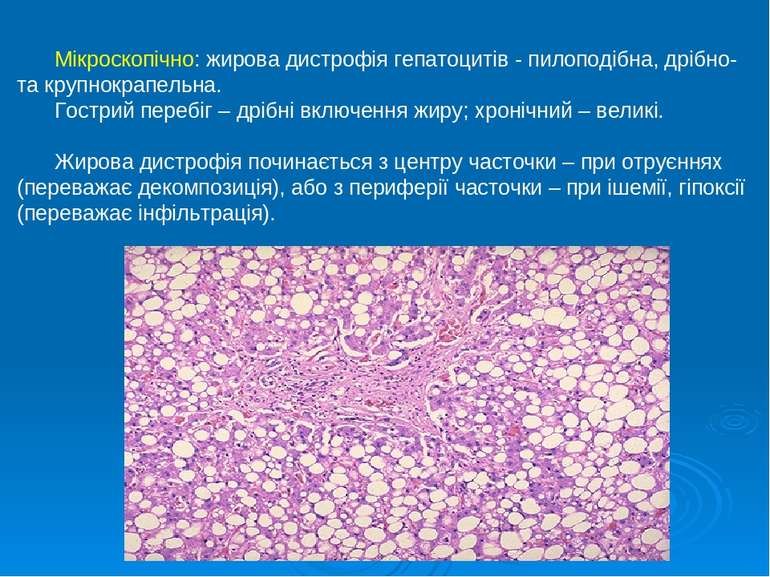 Мікроскопічно: жирова дистрофія гепатоцитів - пилоподібна, дрібно- та крупнок...