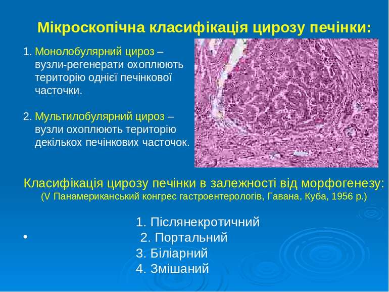 Мікроскопічна класифікація цирозу печінки: 1. Монолобулярний цироз – вузли-ре...