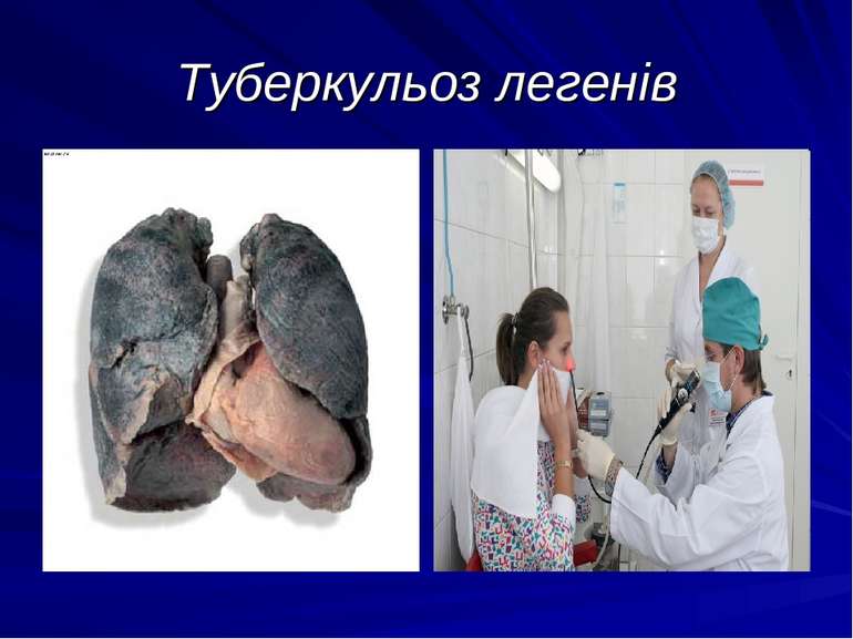Туберкульоз легенів