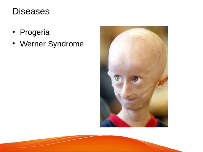 Diseases Progeria Werner Syndrome