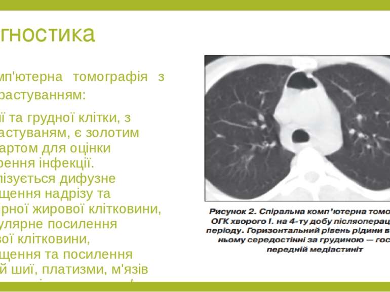 Діагностика Комп'ютерна томографія з контрастуванням: КТ шиї та грудної клітк...