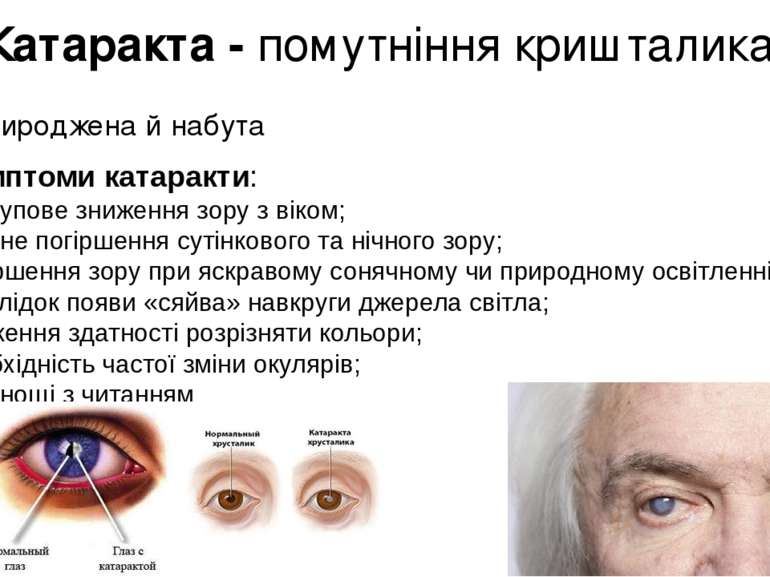 Катаракта - помутніння кришталика Природжена й набута Симптоми катаракти: пос...