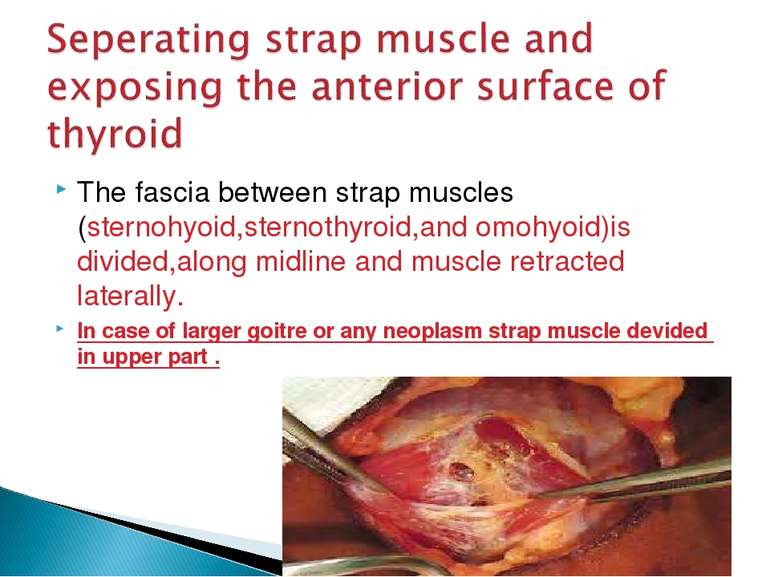 The fascia between strap muscles (sternohyoid,sternothyroid,and omohyoid)is d...