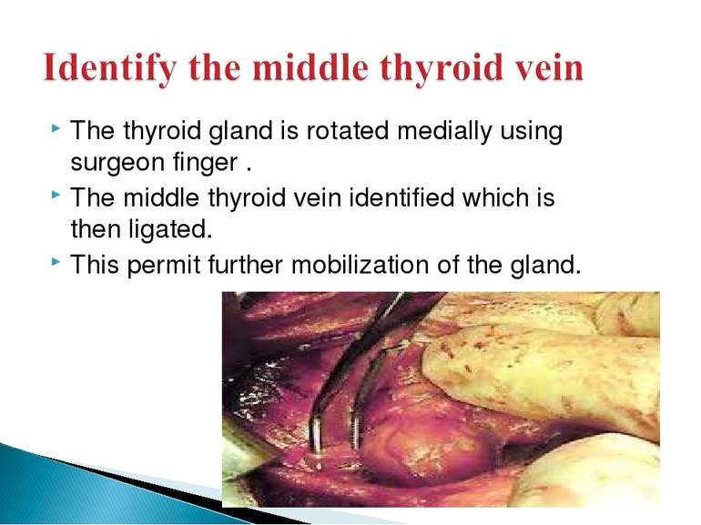 The thyroid gland is rotated medially using surgeon finger . The middle thyro...