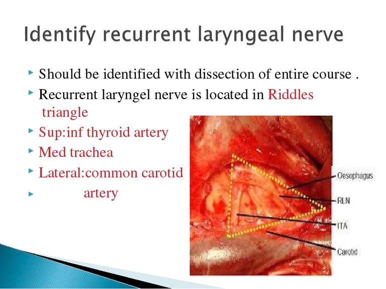 Should be identified with dissection of entire course . Recurrent laryngel ne...
