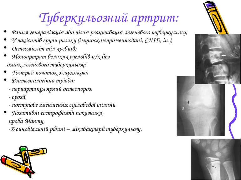 Туберкульозний артрит: Рання генералізація або пізня реактивація легеневого т...